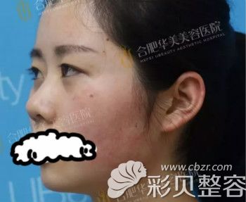 激光去紅血絲術(shù)前側(cè)面照