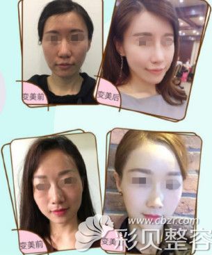 合肥壹加壹面部自體脂肪填充化真人案例