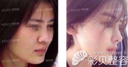 合肥壹加壹?xì)W式隆鼻真人案例：
