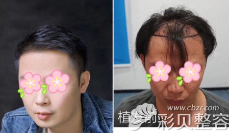 合肥壹加壹無(wú)痕植發(fā)真人案例