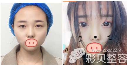 太原時(shí)光精雕無痕雙眼皮案例