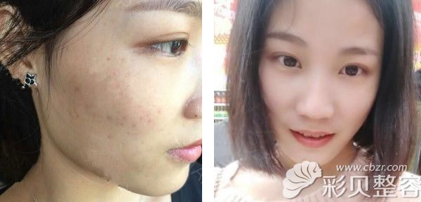 ?？诩t妝尚李杰激光祛斑效果