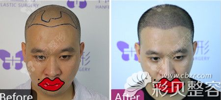 廣州韓妃植發(fā)前后對(duì)比圖片