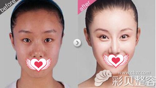 北京華韓雙眼皮案例效果
