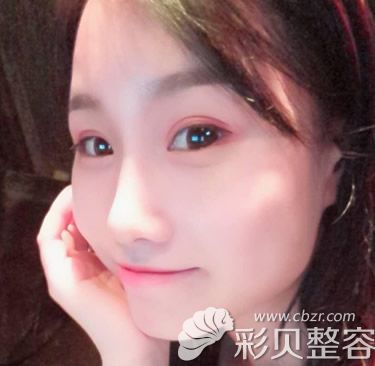 柏麗李勁良隆鼻修復一個月恢復效果