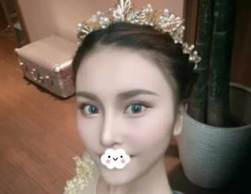妹子找南京維多利亞李志生做綜合鼻整形恢復(fù)效果搶盡風(fēng)頭