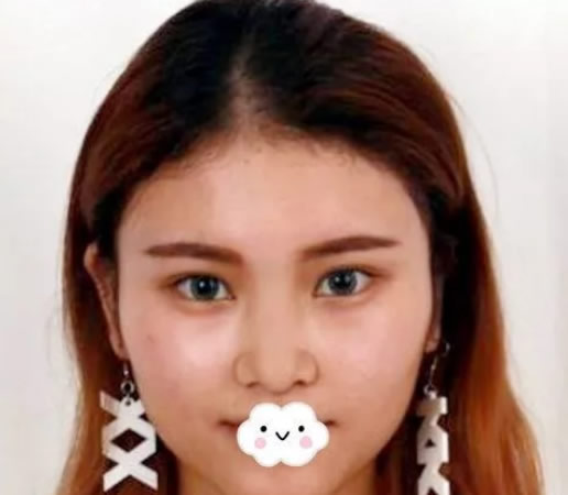 妹子找南京維多利亞李志生做綜合鼻整形恢復(fù)效果搶盡風(fēng)頭
