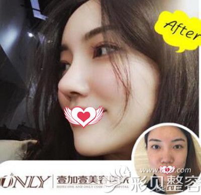 合肥壹加壹整形王大勇隆鼻案例效果 合肥壹加壹整形王大勇隆鼻案例效果
