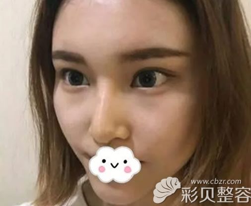 隆鼻第7天圖片