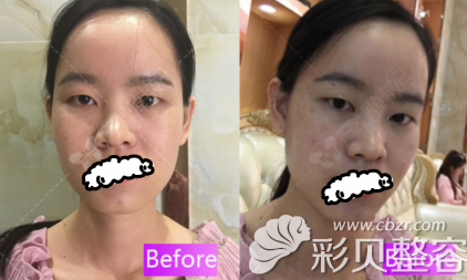 比廣州韓妃和曙光哪個好后我找于洪瑞做雙眼皮前樣子