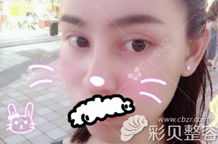 找廣州韓妃于鴻儒做雙眼皮術(shù)后50天效果