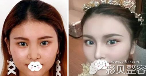 南京維多利亞李志生做鼻綜合前后對比效果案例