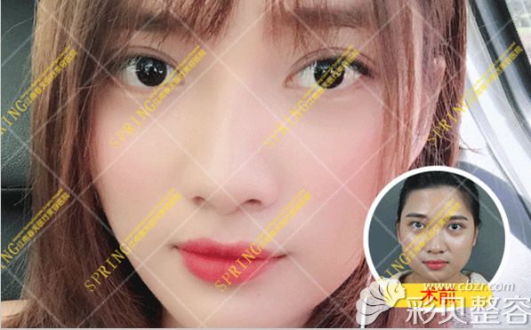深圳江南春天曲娜醫(yī)生瘦臉針注射前后效果對比 深圳江南春天曲娜醫(yī)生瘦臉針注射前后效果對比