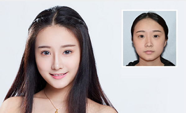 我找深圳江南春天王大太隆鼻和全切雙眼皮后 美得無可救藥