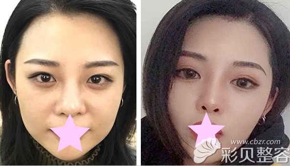 張金梅醫(yī)生做線雕面部脂肪提升效果案例 張金梅醫(yī)生做線雕面部脂肪提升效果案例