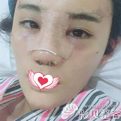 隆鼻+脂肪填充面部術(shù)后當(dāng)天效果圖