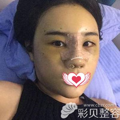 耳軟骨隆鼻+脂肪填充面部術(shù)后1周效果圖