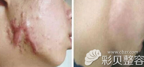 北京亞馨美萊塢疤痕修復(fù)案例