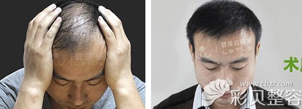 禿頂毛囊植發(fā)3900單位術(shù)后效果案例對比圖