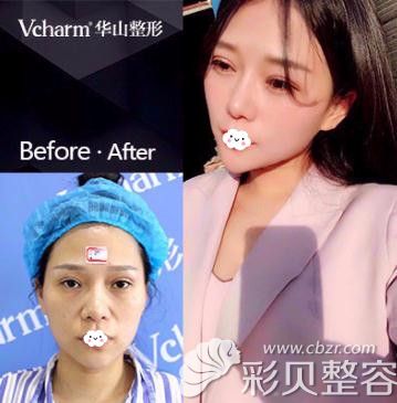 鄭州醫(yī)德佳胡斌假體隆鼻+耳軟骨墊鼻尖案例圖