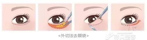 長沙華韓華美外路法去眼袋