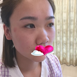 在南京連天美找周長兵做自體肋軟骨隆鼻術(shù)后恢復(fù)效果分享