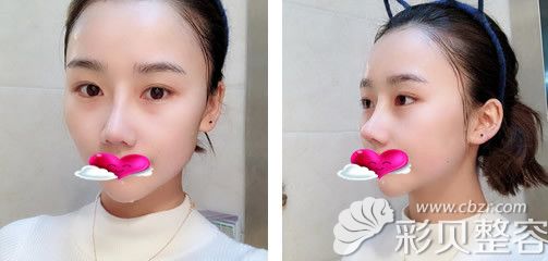 周院長肋軟骨隆鼻術(shù)后恢復(fù)17天效果對比圖