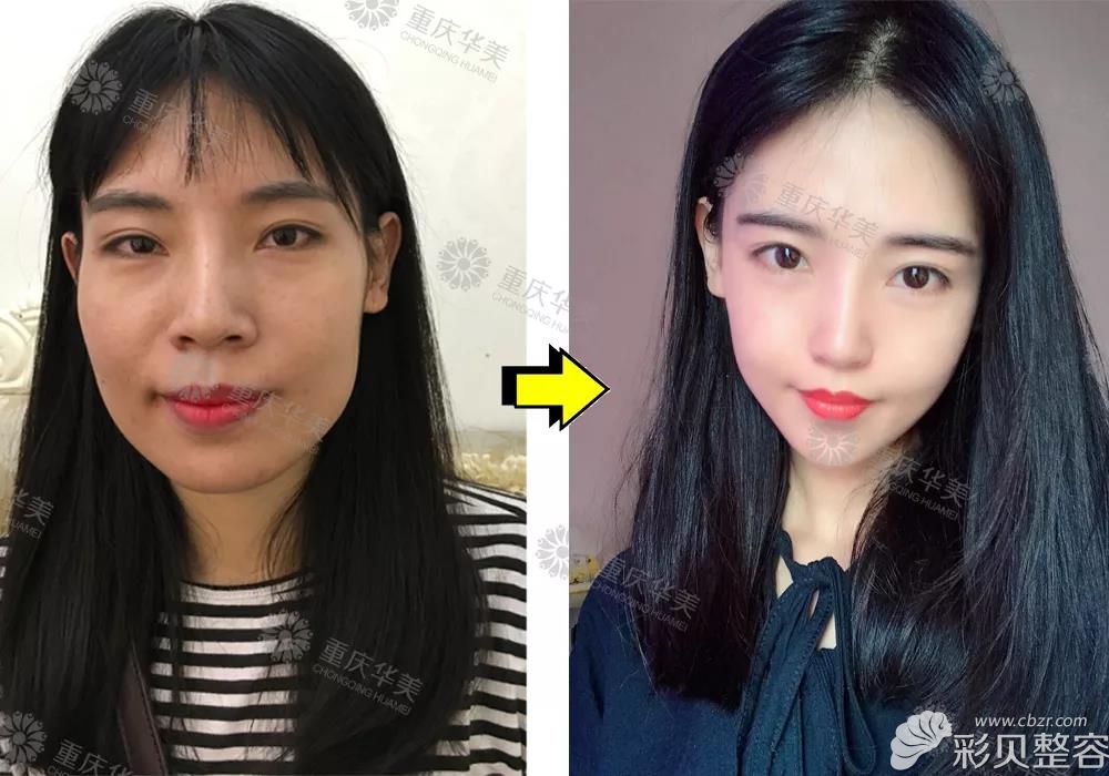 重慶華美潘寶華改臉型效果案例