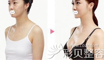 鄭州醫(yī)德佳整形醫(yī)院胡斌假體隆胸案例