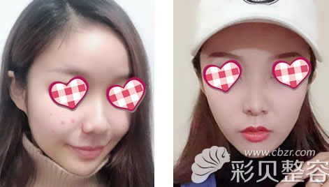 長沙美萊整形潘衛(wèi)峰醫(yī)生面部吸脂術(shù)后13天對比圖 長沙美萊整形潘衛(wèi)峰醫(yī)生面部吸脂術(shù)后13天對比圖
