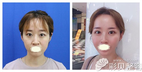康美整形劉道功醫(yī)生全切雙眼皮+開外眼角及臥蠶填充綜合術(shù)后對比照 康美整形劉道功醫(yī)生全切雙眼皮+開外眼角及臥蠶填充綜合術(shù)后對比照