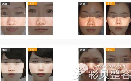 李勁良醫(yī)生的鼻翼縮小案例