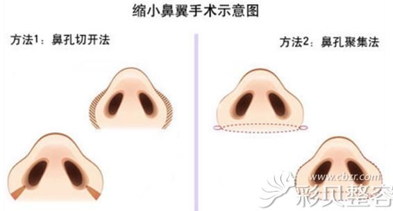 鼻翼縮小手術(shù)示意圖