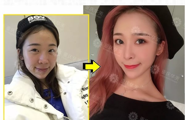 實錘：假體隆鼻老了會怎么樣 隆鼻假體5~10年需要定期更換嗎