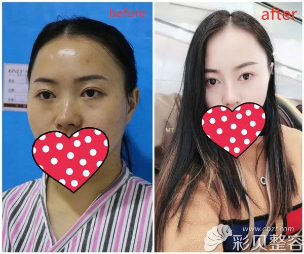 東莞壹加壹整形鼻綜合案例效果對(duì)比圖