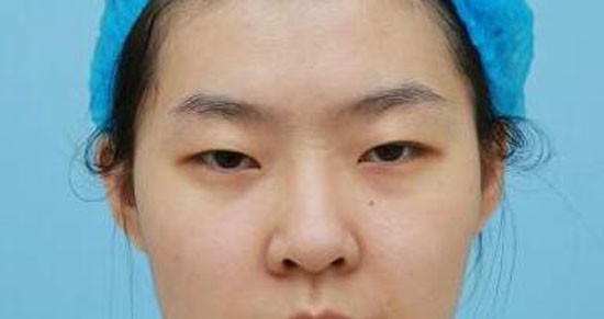 雙眼皮哪種自然?看我在廣元美華做全切雙眼皮兩個(gè)月效果圖