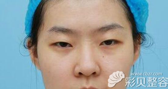 在廣元美華整形割雙眼皮手術(shù)前
