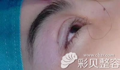 長沙華韓華美埋線雙眼皮效果