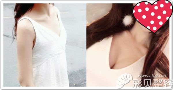 深圳富華整形醫(yī)院隆胸案例效果對(duì)比圖
