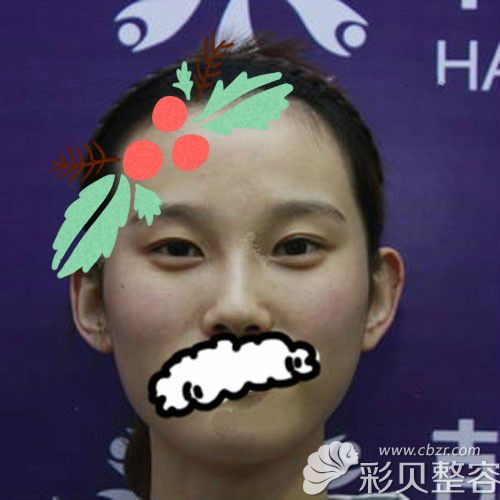 沒去聊城韓美割雙眼皮+開眼角前照片
