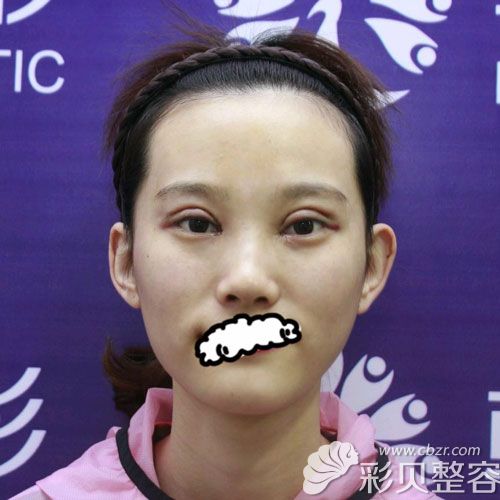 在聊城韓美割雙眼皮+開眼角手術第3天效果