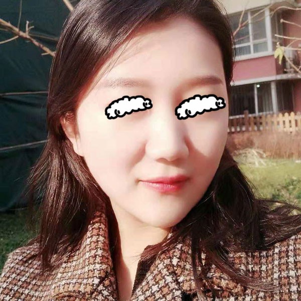 分享聊城韓美倪景輝給我做臉部線雕后的真實感覺和40天效果