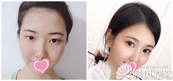 劉駿做眼綜合+全切雙眼皮對比圖