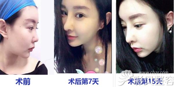 常熟金山整形陳昌馳自體肋軟骨隆鼻+假體隆鼻前后效果對比
