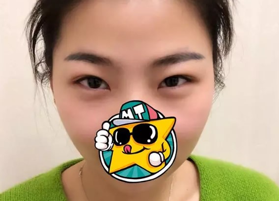 運城哪里做雙眼皮好 看運城麗都楊明峰割雙眼皮效果怎么樣
