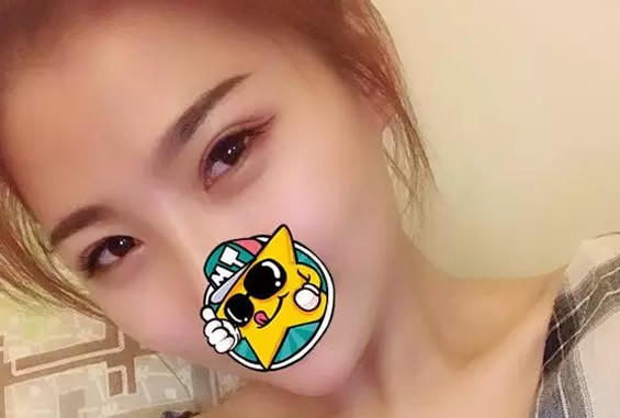 運城哪里做雙眼皮好 看運城麗都楊明峰割雙眼皮效果怎么樣