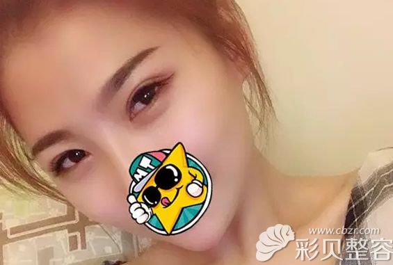 運(yùn)城麗都楊明峰割雙眼皮效果案例
