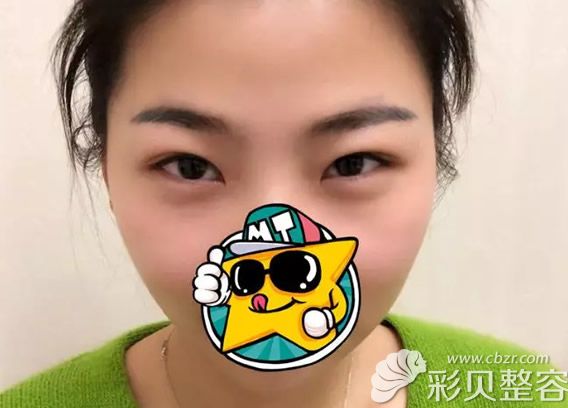 運(yùn)城麗都整形美容醫(yī)院割雙眼皮前