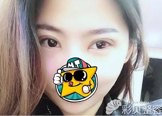 割雙眼皮第七天拆線后