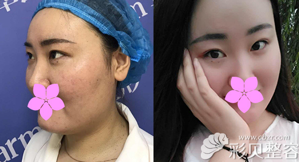 鄭州醫(yī)德佳整形醫(yī)生索惠珠埋線(xiàn)提升案例 鄭州醫(yī)德佳整形醫(yī)生索惠珠埋線(xiàn)提升案例